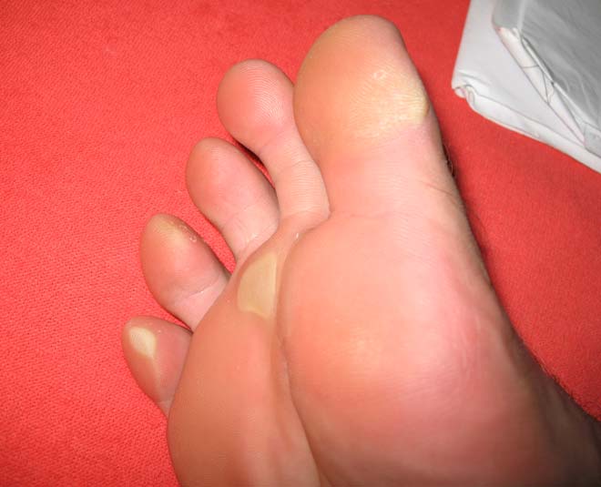 Remove Dead Skin From Your Feet Using 