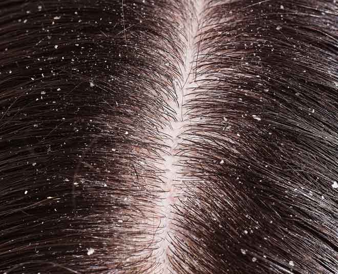 What Causes Dandruff, Is It Contagious?Here Is All You Need To Knowv |  HerZindagi