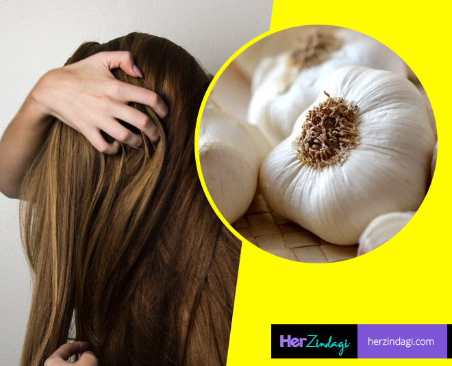 4 Ways You Can Use Garlic Or Lehsun To Treat Baldness, Dandruff And Hair  Thinning | HerZindagi