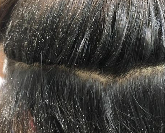 Head lice and nits: risk, detection, treatment and prevention