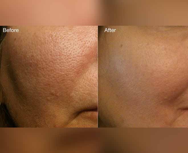 open pores and its probelsm