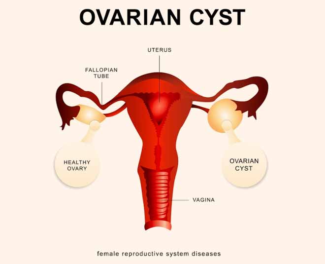 ovarian cysts problem