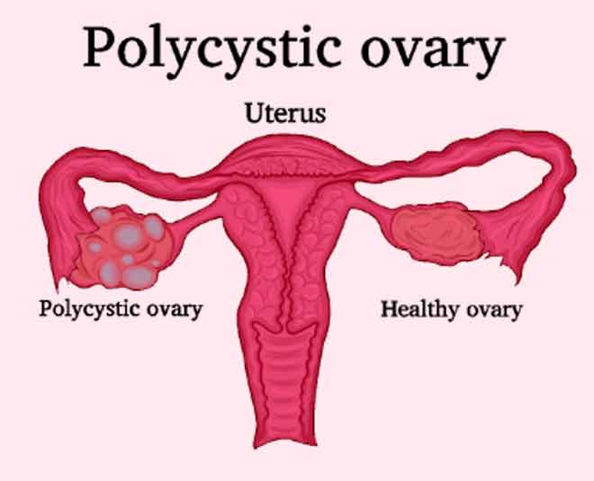 pcos health inside
