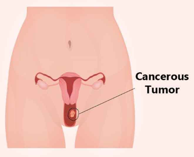 vaginal cancer staging