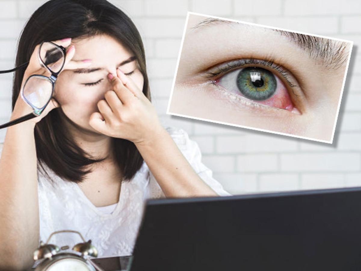 How To Get Rid Of Red Eyes Problem In Hindi