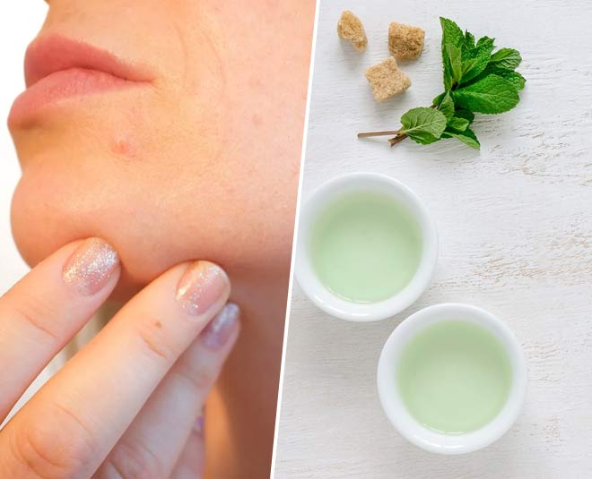 Green Tea With Acne at Bradley Steen blog