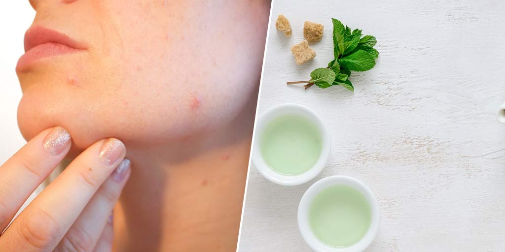 Here Is How Green Tea Solves Acne Problems!Here Is How Green Tea Solves Acne Problems!