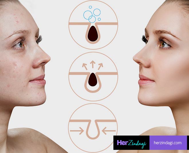 pores with clogged skin