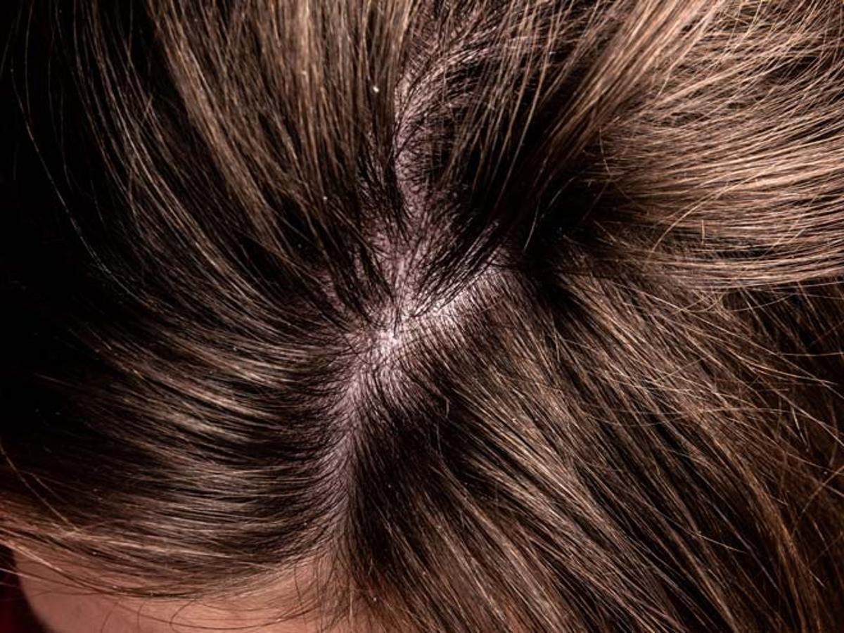 Scalp Scrubbing Has Numerous Benefits For Your Hair | HerZindagi