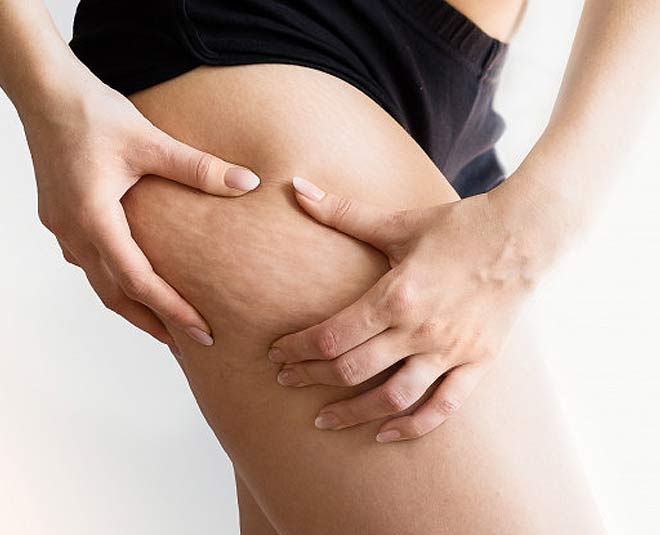 cellulite health main