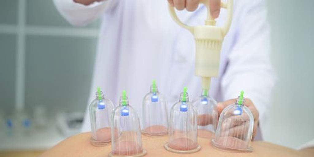 What Is Cupping Therapy? Here Is Everything To Know About ItWhat Is
