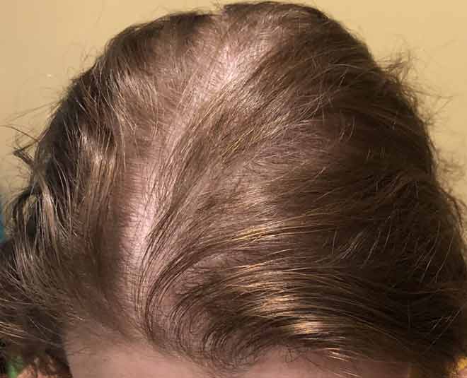 Avoid Baldness, Treat Hair Loss With These Hair Masks | HerZindagi
