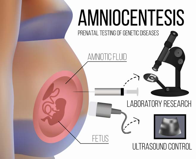 amniocentesis health inside 