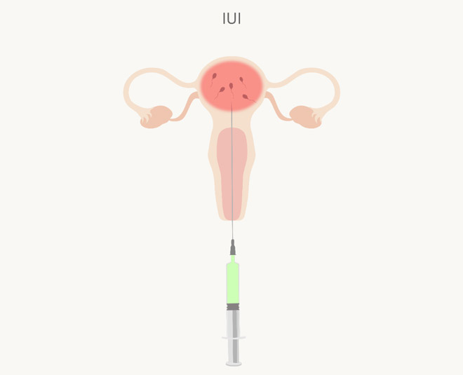 insemination