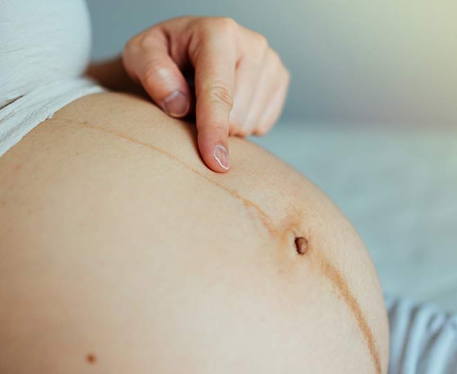 linea nigra during pregnancy inside 