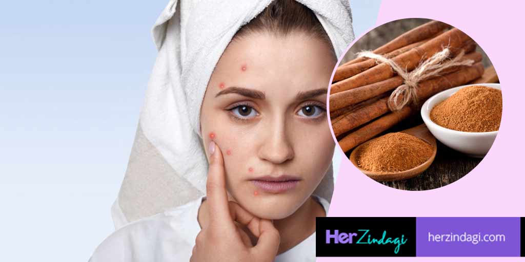 DIY Cinnamon Face Pack For Acne Scars In Hindi DIY दालचीनी से बने इस