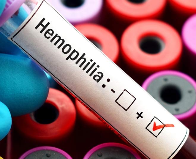 World Haemophilia Day 10 Facts You Must Know About This Condition