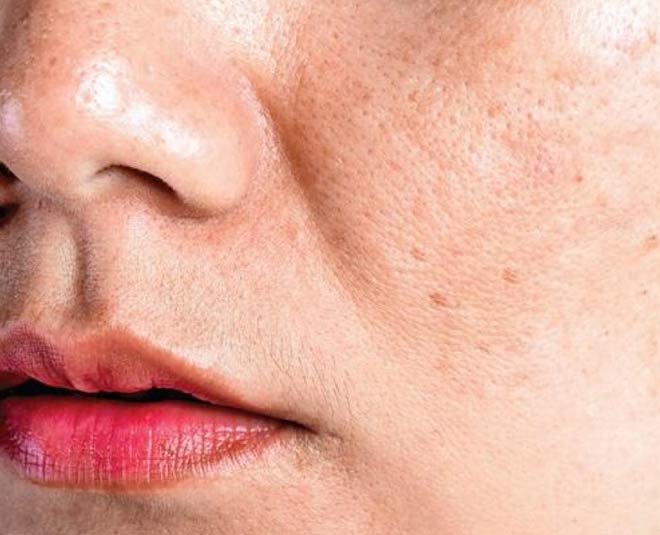 pigmentation mistakes