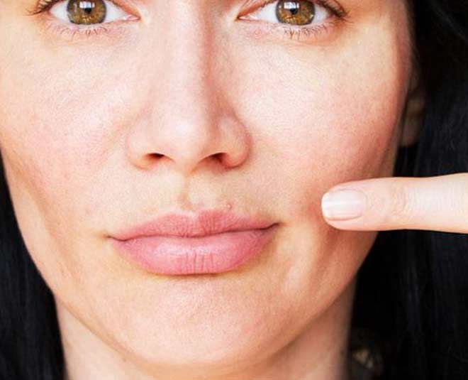 pimples on lips inside 