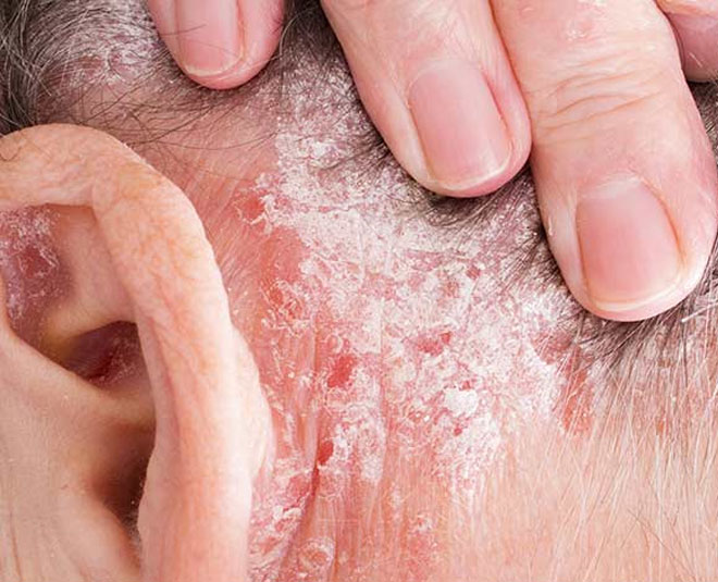 ragi for scalp problem inside 