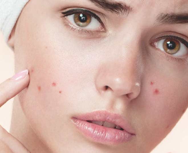 Have Acne Prone Skin? Here Are Some Things You Should Avoid Doing-Have