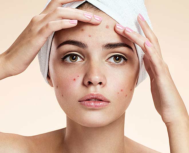 Have Acne Prone Skin? Here Are Some Things You Should Avoid Doing-Have