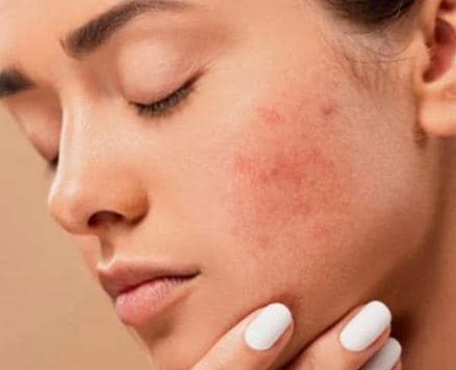 Tips for acne prone skin m