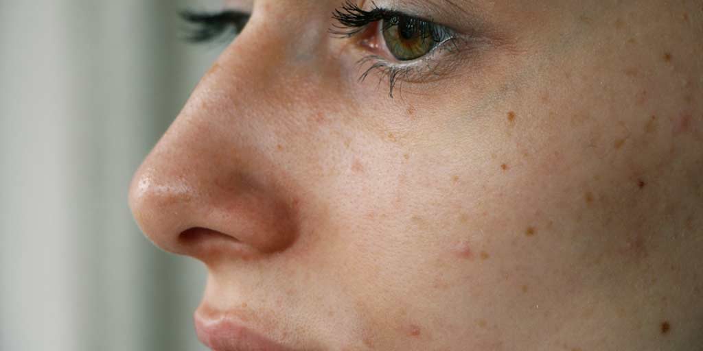 How to Control Tzone Oil Problem on Face नाक और माथे पर हमेशा आता है ऑयल तो करें ये काम