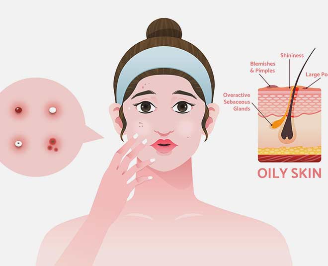 easy to fix oily skin in monsoon