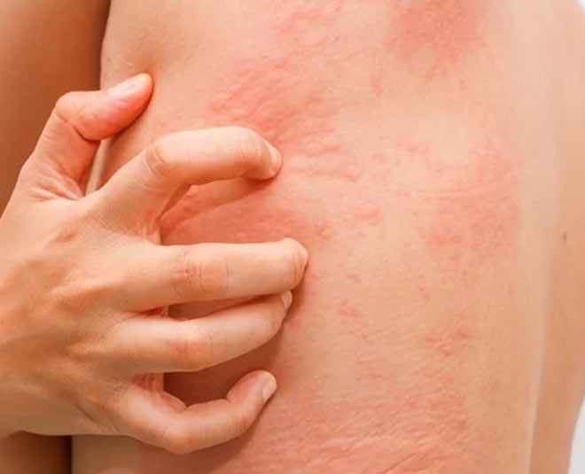 hive monsoon skin allergy