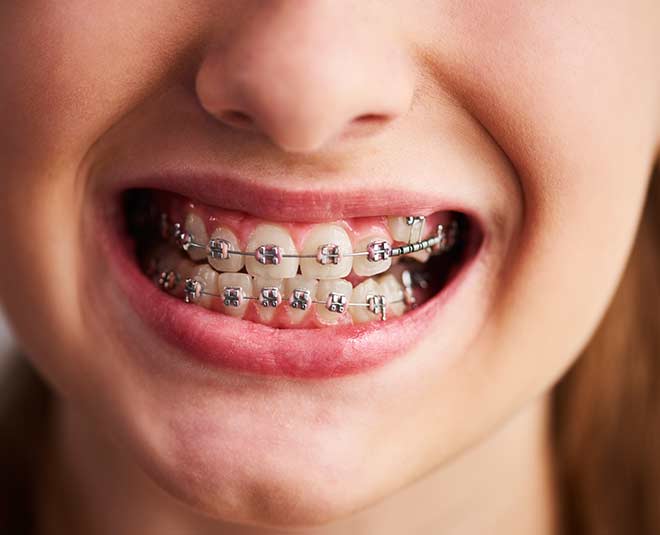 metal braces care tips