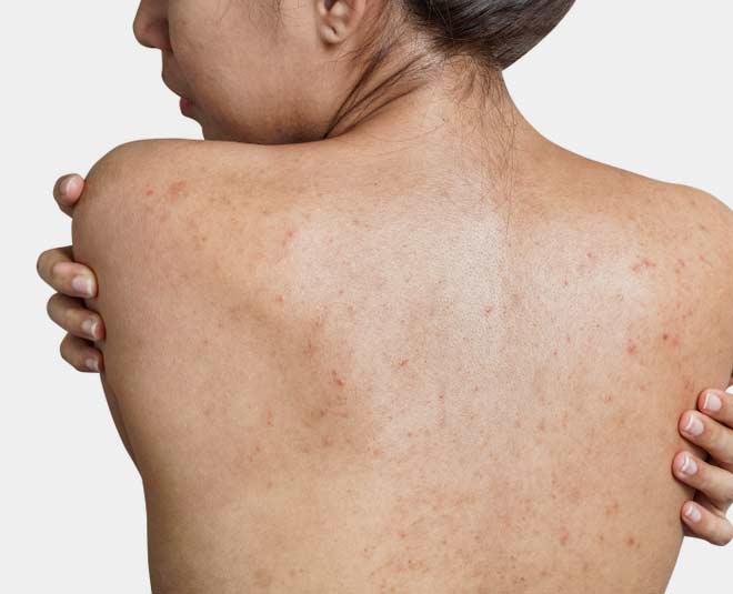 monsoon back acne problems