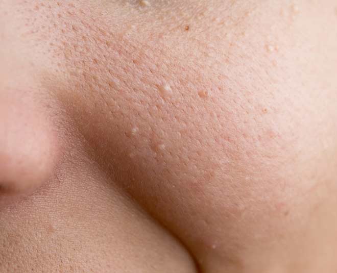 monsoon milia problem