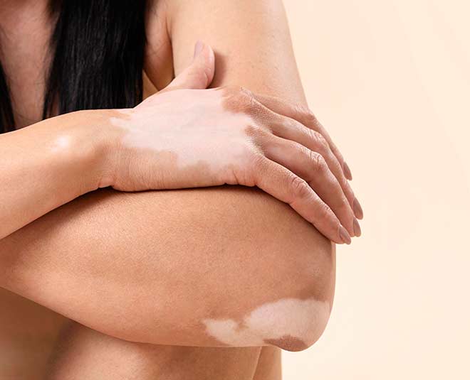 vitiligo common facts myths expert vedas cure