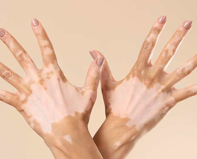 vitiligo tips myths facts