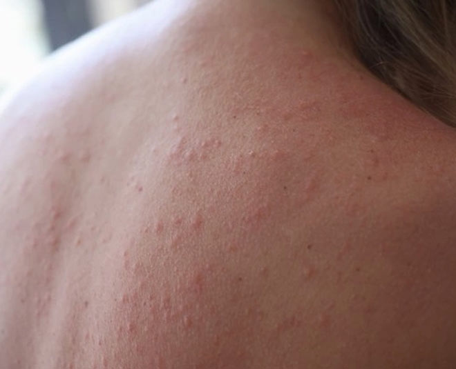 wheal skin allergy in monsoon