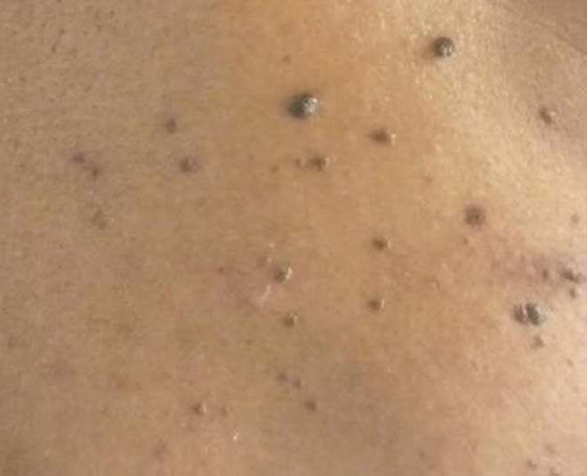 dematosis and skin bump