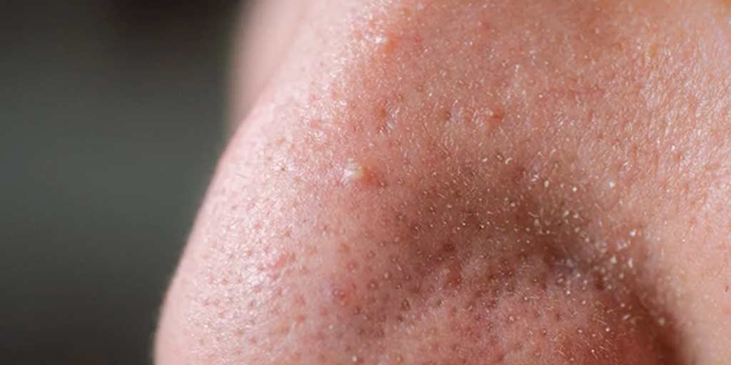 4-different-kinds-of-bumps-on-face-and-their-symptoms-4-different