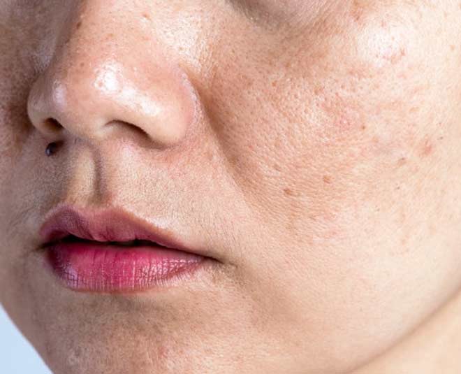 how to remove open pores on face