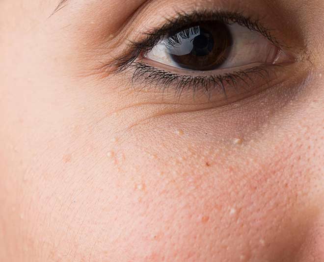 milia and skin bumps