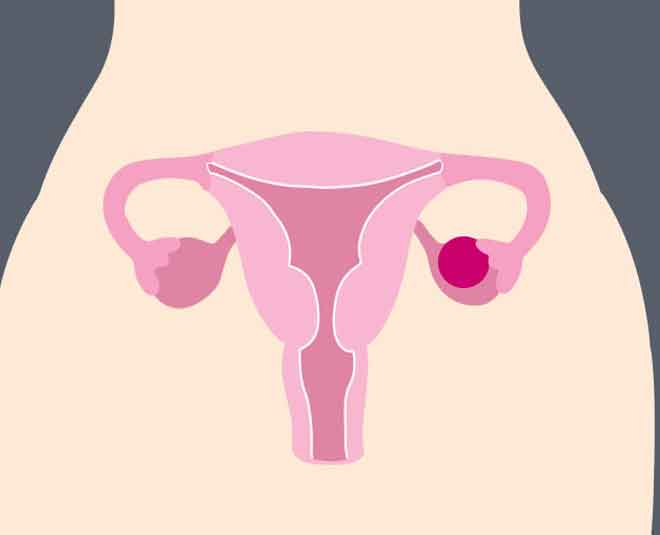 ovarian cyst main