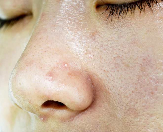problems with oily skin