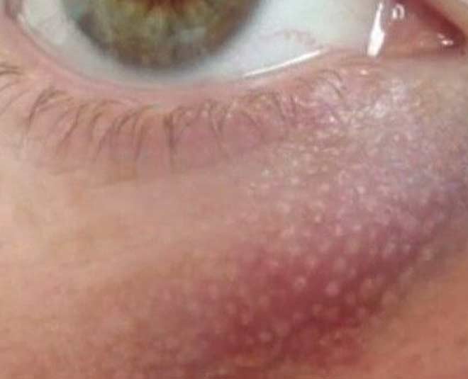 sersocoma and skin bump