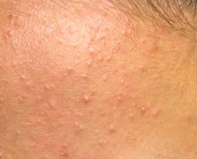 whiteheads and skin bumps