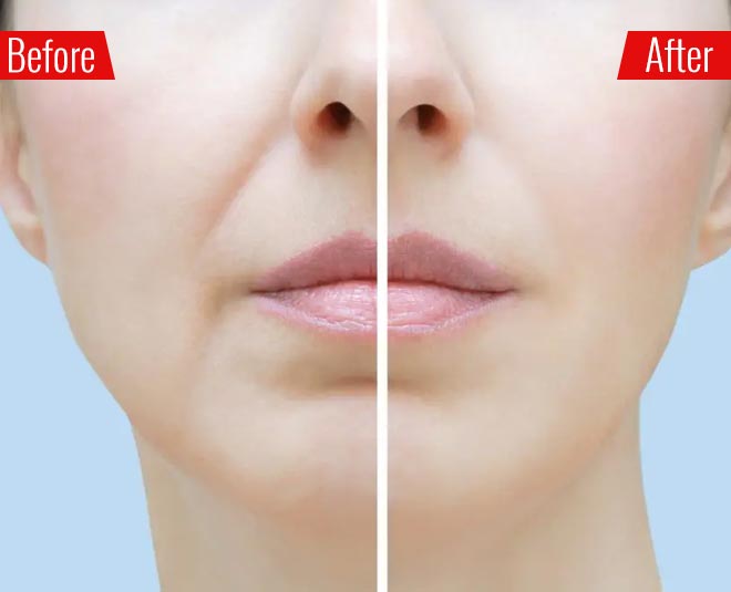 Facial Yoga To Remove Wrinkles And Line Around Lips By Expert