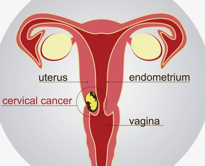 cervical cancer inside 