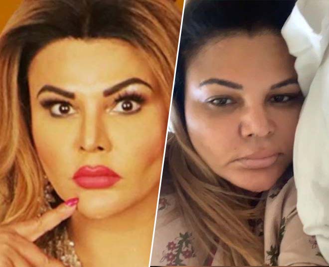 राखी सावंत rakhi sawant face injury