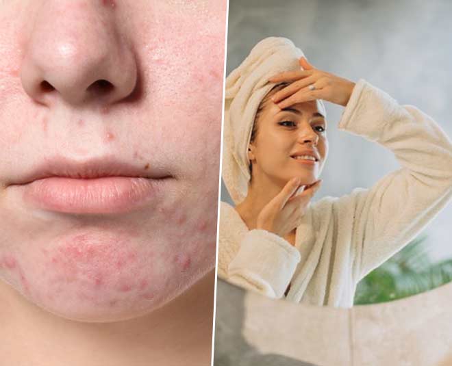 5-best-ways-to-deal-with-pimples-around-the-mouth-5-best-ways-to-deal