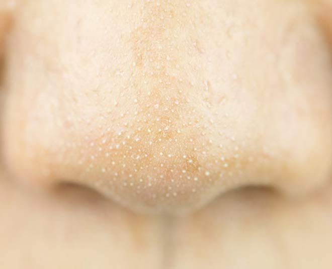 Easy Blackheads Removal Tips With Kitchen Ingredients easy blackheads removal tips with