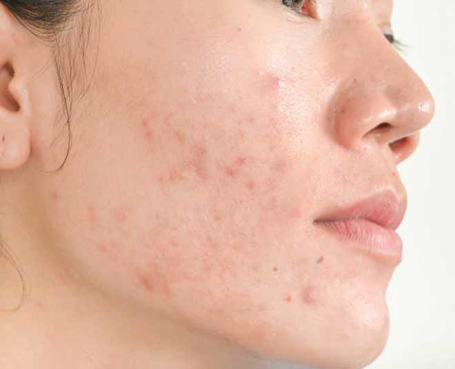 skin scar treatment shahnaz